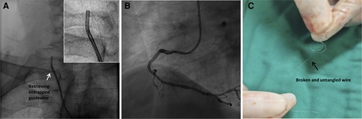 Retrieval of the fractured guidewire. (A). The entrapped guidewire was retrieved. (B). The blood flow in RCA was restored. (C). Retrieved broken guidewire.