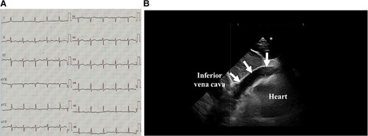 The 12-lead electrocardiograms (A) and echocardiography (B) on admission. The white arrows in Figure 1B delineate a pericardial effusion.