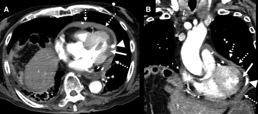 Horizontal (A) and vertical (B) images of the contrast cardiac computed tomography revealed a pericardial effusion (dotted white arrows), poor contrasting of the postero-lateral wall of the left ventricle (white arrows), and leakage of contrast into the pericardial space (triangle arrows).