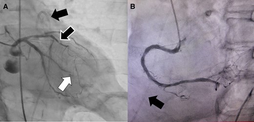 An emergent coronary angiography revealed an occlusion of the distal site of the left circumflex (LCX)-obtuse marginal (OM) artery without any collateral vessels (white arrow) (A), 75% stenosis of the left anterior descending artery (black and white arrow) (A), and no significant stenosis of the right coronary artery (B). The black arrow shows a pericardial drain.