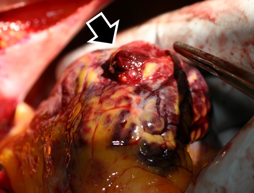 The findings during the operation demonstrated a 3 cm left ventricular free wall rupture (black and white arrow).