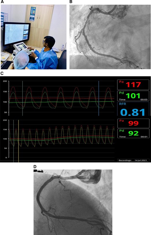 (A) The interventional cardiologist performing robotic percutaneous coronary intervention from the robotic console situated outside the radiation field. (B) Severe long-segment mid-right coronary artery disease, multiple side branches. (C) Resting Pd/Pa and baseline resting full-cycle ratio. (D) Final result.
