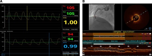 (A) Post-procedure Pd/Pa and resting full-cycle ratio. (B) Post-procedure optical coherence tomography.