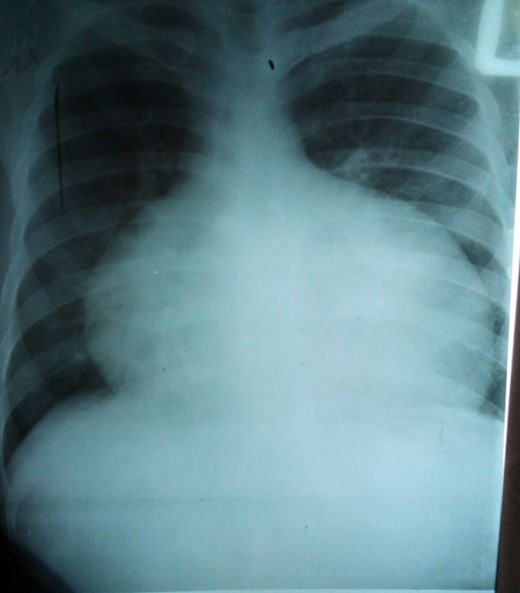 Chest x-ray showing marked symmetric cardiomegaly.