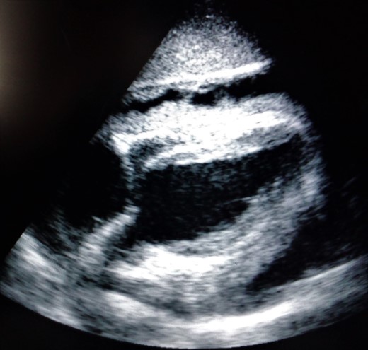 Echocardiogram showing pericardial effusion.