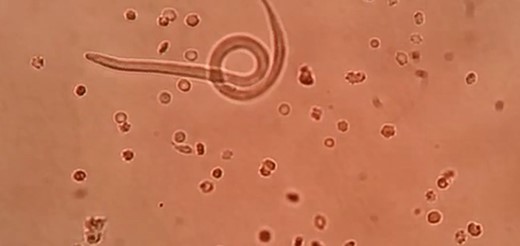 Wet mount preparation of pericardial fluid showing Trichinella spiralis.