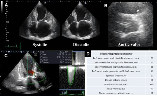 Echocardiographic assessment. (A) Echocardiographic showed left ventricular contractility, (B) aortic valve at axial view, (C) echocardiography continuous-wave Doppler across the aortic valve, and (D) echocardiographic parameters.