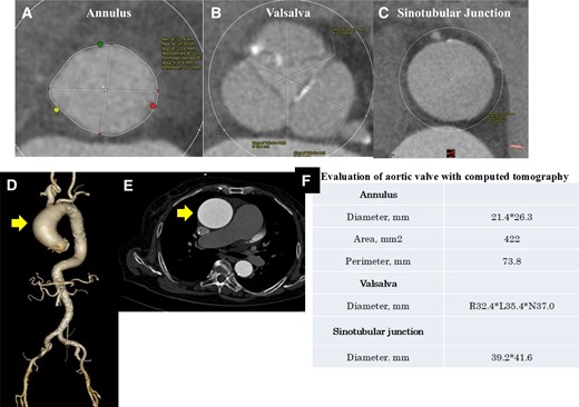 Evaluation of the aortic valve and access route with computed tomography. (A–C) The aortic valve at axial view. (D) The aorta in three-dimensional view. (E) The ascending aorta at axial view. Ascending aortic dilatation of 57 × 58 mm was observed. (F) Evaluation of the aortic valve with computed tomography.