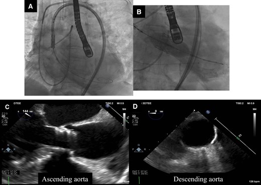 Valve delivery and implantation and aortic evaluation with transoesophageal echocardiography during transcatheter aortic valve implantation. (A) The prosthetic valve was delivered carefully. (B) The prosthetic valve was implanted at pressure of nominal −2 cc. (C and D) There were no injuries to the ascending and descending aorta.
