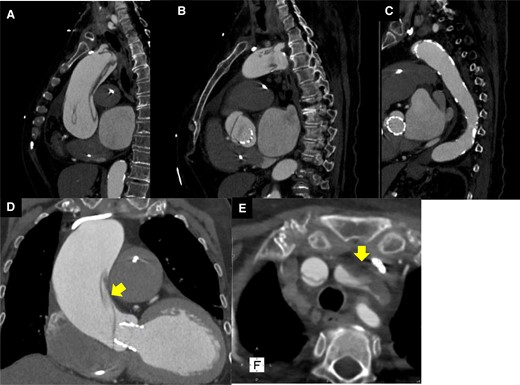 Computed tomography on the second day after transcatheter aortic valve implantation. (A–C) Aortic dissection was observed in the ascending aorta. (D) The entry of aortic dissection. (E) Left internal carotid artery occlusion.