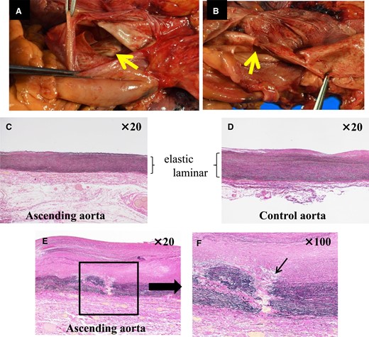 Macroscopic findings and microscopic findings at autopsy (Elastica Van Gieson stain). (A and B) There was a dissection entry 5 cm distal to the prosthetic valve position. (C) Ascending aorta. (D) Control aorta. The elastic laminar was thinning in the ascending aorta compared with the control aorta. (E and F) The arrow indicated fragmentation to the elastic laminar.