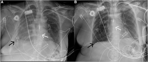 Left panel: Chest X-ray on day 16, showing a unilateral pleural effusion on the right side (black arrow), for which a diagnostic pleural punction was performed to exclude empyema. The Impella™-device is shown by the white arrow. Right panel: Chest X-ray on day 17 after pleural drainage and insertion of a pig tail catheter (black arrow), which resulted in full drainage of the pleural effusion.