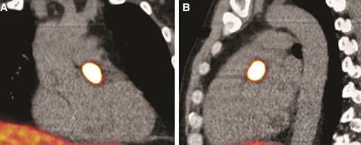 (A) 68Ga-octreotide positron emission tomography–computed tomography coronal plane demonstrates an active mass in the heart suspected of a cardiac paraganglioma, size 23 × 11 mm. (B) 68Ga-octreotide positron emission tomography–computed tomography in the sagittal plane shows the active mass.