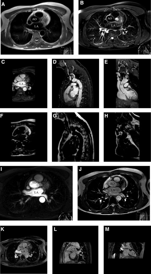 (A) Axial plane black blood turbo spin echo T1-weighted cardiac magnetic resonance imaging, tumour shows an intermediated signal. (B) Axial plane, black blood turbo spin echo T2-weighted spectral attenuated inversion recovery that suppresses fat, tumour shows a high signal, indicating a lack of fat content. (C–E) Axial, sagittal, and coronal plane of mDixon water reconstruction T1-weighted three-dimensional non-contrast-enhanced magnetic resonance angiography with respiratory navigator gating, showing an intermediate tumour signal. (F–H) Axial, sagittal, and coronal plane of mDixon fat reconstruction T1-weighted three-dimensional non-contrast-enhanced magnetic resonance angiography with respiratory navigation gating, indicating the absence of fatty content in the tumour. (I) Axial plane of the perfusion image in which contrast appears in the tumour in the late arterial phase. (J) Axial plane of the cine TRA bTEE and (K–M) axial, sagittal, and coronal plane show the absence of late gadolinium enhancement. The white arrow points to the tumour in all panels. Ao, aorta; bTEE, balanced turbo field echo; LA, left atrium; LV, left ventricle; PA, pulmonary artery; TRA, transverse.