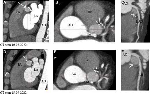 (A–C) (Sagittal, axial, and curved planar reformatted plane) Computed tomography of 10 February 2022 showed an intracardiac lesion caudal from the left main that transitions into the left anterior descending of 18 × 14 × 14 mm without encasement of the left main or left anterior descending. (D–F) (Sagittal, axial, and curved planar reformatted plane) A repeated computed tomography scan shows growth of the suspected paraganglioma. Size 20 × 17 × 14 mm. The white arrow points to the tumour. AO, aorta; LA, left atrium; LAD, left anterior descending; LM, left main; RV, right ventricle; PA, pulmonary artery.