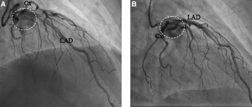 (A) −35/29 RSO and (B) −35/2 RAO, coronary angiography showing the inflow of contrast into the tumour. Cx, circumflex artery; LAD, left anterior descending artery; RAO, right anterior oblique; RSO, superior angulation. The dashed circle points at the tumour.