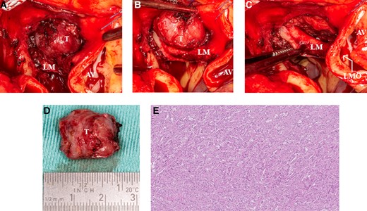 (A) Intraoperative image of the cardiac mass. (B) Intraoperative view of the close relation with the left main artery and the left anterior descending artery. (C) Image of the excised cardiac paraganglioma. (D) Image of the small defect of the left main artery meaning that the left anterior descending artery was the feeding artery. (E) Histopathology of the mass shows a Zellballen pattern. Haematoxylin–eosin stain ×5 original magnification. AV, aortic valve; LF, left main; LMO, left main ostium; T, tumour.