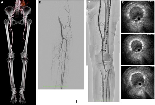 Computed tomography angiogram post-endovascular treatment (A). Control angiogram showed left popliteal artery occlusion from the left dorsalis pedis (B). The final angiogram revealed good blood flow from the superficial femoral artery down to the lesion below the knee (C). Intravascular ultrasound showed excellent expansion and apposition of the placed stents (D).