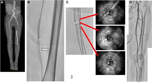 Computed tomography angiogram showed total occlusion from ostial superficial femoral artery to popliteal artery (A). The angiogram revealed a gap (white arrow) between the stents that were previously implanted (B). According to the intravascular ultrasound results, there was a significant amount of thrombus in the stents and evidence of neointimal hyperplasia in the gap (C). Successful revascularization of the superficial femoral artery to popliteal artery (D).