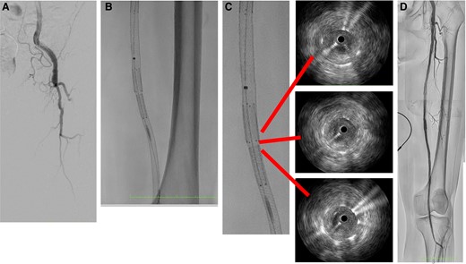 The initial angiogram revealed total occlusion of the superficial femoral artery ostium (A). In the gap, paclitaxel-eluting stent was implanted (B). Intravascular ultrasound showed good expansion and apposition of the overlap and gap lesion (C). The final result was a significant improvement in blood flow (D).