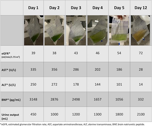 The greenish urine returns to normal colour with the improvement of daily urine output, brain natriuretic peptide, renal function, and liver function.