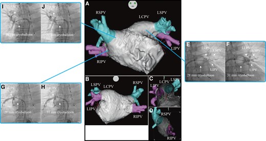 Three-dimensional images obtained through a multi-slice CT scan of Case 1 in the anteroposterior (A), posteroanterior (B), right-lateral (C), and left-lateral (D) views. Venogram of the LCPV during cryoballoon ablation using the 28 mm (E) and 31 mm (F) modes. Venogram of the RIPV during cryoballoon ablation using the 28 mm (G) and 31 mm (H) modes. Venogram of the RSPV during cryoballoon ablation using the 28 mm (I) and 31 mm (J) modes. CT, computed tomography; LCPV, left common pulmonary vein; RIPV, right inferior pulmonary vein; RSPV, right superior pulmonary vein.