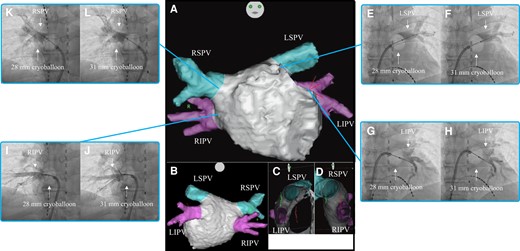 Three-dimensional images obtained through a multi-slice CT scan of Case 2 in the anteroposterior (A), posteroanterior (B), right-lateral (C), and left-lateral (D) views. Venogram of the LSPV during cryoballoon ablation using the 28 mm (E) and 31 mm (F) modes. Venogram of the LIPV during cryoballoon ablation using the 28 mm (G) and 31 mm (H) modes. Venogram of the RIPV during cryoballoon ablation using the 28 mm (I) and 31 mm (J) modes. Venogram of the RSPV during cryoballoon ablation using the 28 mm (K) and 31 mm (L) modes. CT, computed tomography; LIPV, left inferior pulmonary vein; LSPV, left superior pulmonary vein; RIPV, right inferior pulmonary vein; RSPV, right superior pulmonary vein.