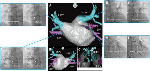 Three-dimensional images obtained through a multi-slice CT scan of Case 3 in the anteroposterior (A), posteroanterior (B), right-lateral (C), and left-lateral (D) views. Venogram of the LSPV during cryoballoon ablation using the 28 mm (E) and 31 mm (F) modes. Venogram of the LIPV during cryoballoon ablation using the 28 mm (G) and 31 mm (H) modes. Venogram of the RIPV during cryoballoon ablation using the 28 mm (I) and 31 mm (J) modes. Venogram of the RSPV during cryoballoon ablation using the 28 mm (K) and 31 mm (L) modes. CT, computed tomography; LIPV, left inferior pulmonary vein; LSPV, left superior pulmonary vein; RIPV, right inferior pulmonary vein; RSPV, right superior pulmonary vein.