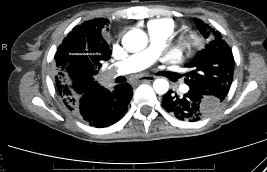 Computed tomographic pulmonary angiogram demonstrating an occlusive thromboembolism in the right pulmonary artery in Patient 1. RPA, right pulmonary artery.