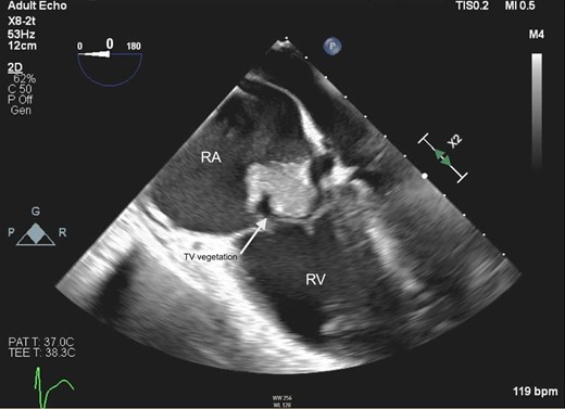 Mid-oesophageal four-chamber view on transoesophageal echocardiography demonstrating mobile tricuspid valve vegetation in Patient 1. RA, right atrium; RV, right ventricle; TV, tricuspid valve.