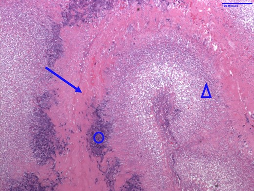 Haematoxylin and eosin stain of tricuspid valve vegetation specimen from Patient 1 indicative of fungal endocarditis. Arrow = fibrin; circle = acute inflammation; triangle = fungal colonies consistent with Candida albicans.