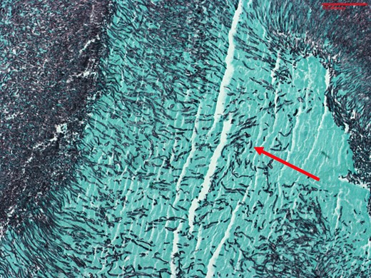 Grocott methenamine silver stain of the tricuspid valve vegetation specimen from Patient 1 demonstrating fungal organisms consistent with Candida albicans pseudohyphae. Arrow = fungal organism.
