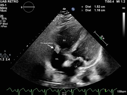Subcostal four-chamber view on transthoracic echocardiogram demonstrating tricuspid valve vegetation in Patient 2. LA, left atrium; LV, left ventricle; RA, right atrium; RV, right ventricle; TV, tricuspid valve.
