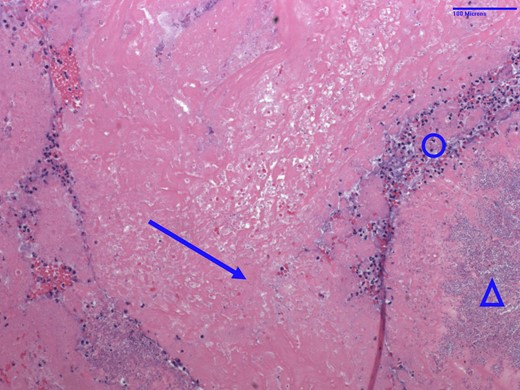Haematoxylin and eosin stain of tricuspid valve vegetation specimen from Patient 2. Arrow = fibrin; circle = acute inflammation; triangle = bacterial bacilli colonies consistent with Pseudomonas aeruginosa.