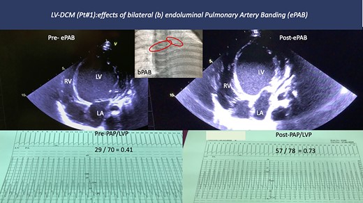 Pre- an and immediate post-interventional results after bilateral (b) endoluminal (e) pulmonary artery banding of Patient #1. Transcatheter placed bilateral pulmonary flow restrictors resulted in an immediate increase of the pulmonary artery pressure, while the ratio of the systolic pulmonary artery pressure to the left ventricular systolic pressure increased from 0.41 to 0.73. Note, that the ventricular septum shifted from right to left with functional improvement of the left ventricular function.