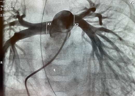 Pulmonary artery angiography of Patient #2 with measurements of right and left pulmonary artery branch diameters.