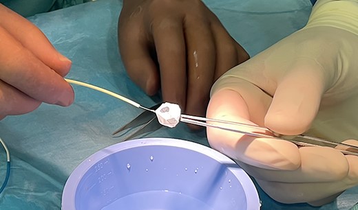 Medtronic vascular plug (MVP-7Q) manually prepared as a pulmonary flow restrictor by removal of one polytetrafluoroethylene covered end cell (Patient #2).