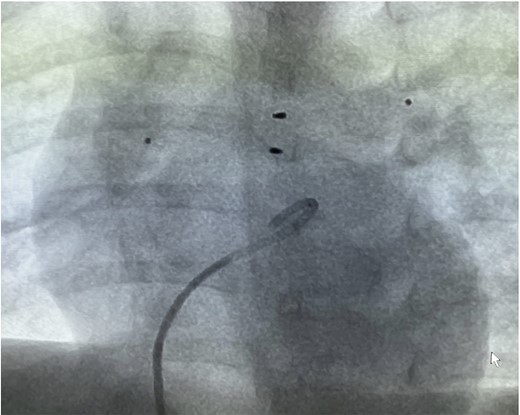 Depicted are the pulmonary flow restrictors positioned within the right and left pulmonary branch arteries of Patient #2.