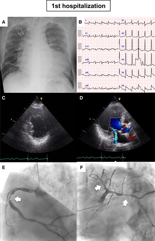 Imaging data on 1st admission. (A) Chest radiography. (B) Electrocardiography. (C) Parasternal short-axis view. Posterior asynergy was noted. (D) Apical three-chamber view. (E) Right coronary artery, (F) left coronary artery. White arrows indicate the significant stenosis.
