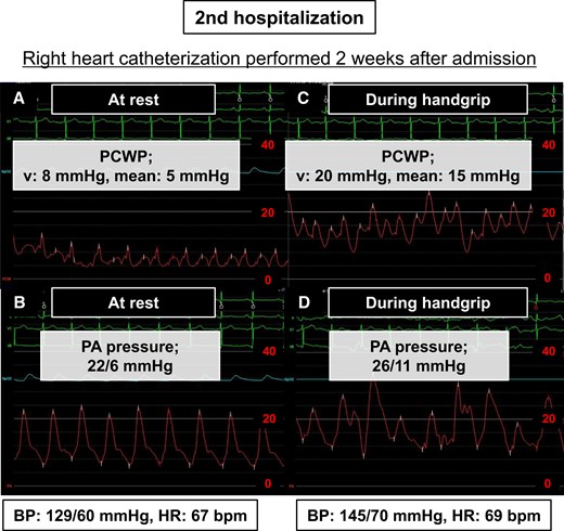 Data of right heart catheterization performed 2 weeks after 2nd admission. (A) PCWP at rest, (B) PA pressure at rest, (C) PCWP during handgrip, (D) PA pressure during handgrip. BP, blood pressure; HR, heart rate; PA, pulmonary artery; PCWP, pulmonary artery wedge pressure.