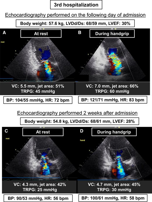 Transthoracic echocardiography at rest and during isometric handgrip, performed on the following day of the 3rd admission and after stabilizing HF condition. (A) At rest on the following day of the 3rd admission, (B) during handgrip on the following day of the 3rd admission, (C) at rest after stabilizing HF condition, (D) during handgrip after stabilizing HF condition. BP, blood pressure; HR, heart rate; LVDd/Ds, left ventricular end-diastolic diameter/end-systolic diameter; LVEF, left ventricular ejection fraction; TRPG, tricuspid regurgitation pressure gradient; VC, vena contracta width.