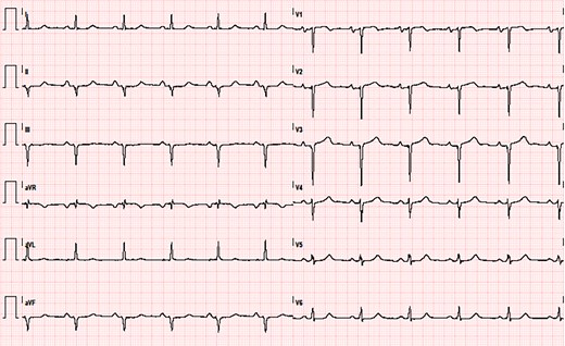 ECG showing sinus rhythm, left atrial enlargement, left anterior fascicular block, and anterior and inferior necrosis.