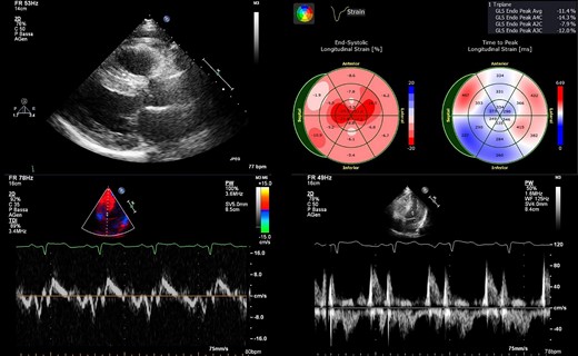 Main echocardiographic findings. (upper left) Parasternal long-axis view showing severely increased interventricular septum thickness (20 mm). (upper right) Strain analysis showing the ‘apical sparing pattern’ with the exception of the limited infarcted area. (bottom left) Tissue Doppler imaging showing a reduced E′ septal velocity. (bottom right) Diastolic trans-mitral flow showing pseudo-normal pattern.