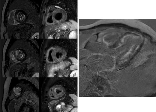Cardiac magnetic resonance. The left side of the panel on the left shows the diffuse subendocardial late gadolinium enhancement pattern in the absence of a coronary pattern distribution in short axis images. The right side of the panel on the left shows the absence of oedema. From top to bottom: basal segments, mid segments and apical segments. The panel on the right reports the four-chamber delayed enhancement image showing the diffuse subendocardial enhancement, the atrial enhancement, and the limited apical necrosis.