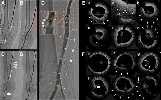 Superficial femoral artery in the lower right leg: (A–D, G) angiographies; (E, F) optimal frequency domain imaging. (A) Before treatment: chronic total occlusion in the distal segment (dotted line) and severe stenosis in the popliteal artery (solid line). (B) After stent-graft implantation (dotted line). (C) Stent-graft with significant restenosis at the edge of the proximal segment (arrowheads) and mild stenosis in the mid to distal segment (dotted line), and restenosis at the site of previous balloon angioplasty in the popliteal artery (arrow). (D) Magnification of the proximal edge (a–d) and the superficial femoral artery (e–j). (E, F) Evaluation of the morphological features of the heterogenous neointima in the restenotic stent-graft. (a) Proximal segment: gradual signal attenuation with outer and inner bands of low and high signal intensity, respectively (arrowheads). (a′) Magnification (dotted square): microvessels within the outer layer (arrows). (b) Mid-segment: greater proportion of low-signal-intensity band (arrowheads). (c) Double lumen appearance, from which the low-signal-intensity band seems to move away (asterisk), and heterogeneous neointima. (c′) Postoperative dilation of restenosis after compression of the neointima at the same cross-section of (c). (d) Distal segment: protruding mass with irregular borders and relatively strong signal attenuation with visible strut suggesting recent thrombus (arrowheads). (e) Proximal segment of the stent’s midsection: cover of the thin endothelium. (f, i) Gradual signal attenuation of heterogeneous neointima, similar to (b) but with a thinner high-intensity inner band. A gradual increase of low-signal-intensity band from the proximal to the distal segment of mild neointimal hyperplasia (arrowheads). (g) Irregular luminal margins implicating small mural thrombi on the surface (arrow). (h) Protruding mass with irregular surface and relatively strong signal attenuation, similar to (d) (arrow). (j) Heterogeneous tissue, mostly with low backscatter and speckled pattern with a visible strut (arrowheads). (G) Final image after treating the restenosis.