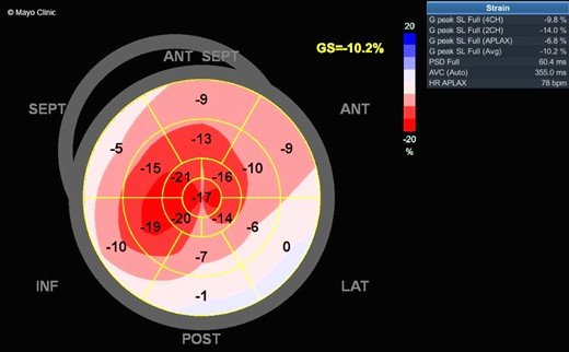 Myocardial strain imaging demonstrating abnormal global longitudinal strain of −10.2% with apical sparing.