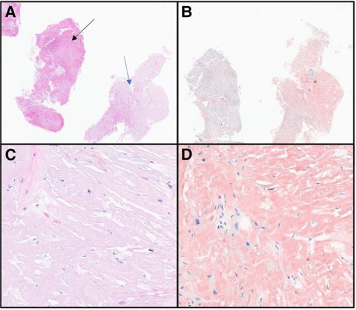 (A) Haematoxylin and eosin 2×. Tissue on the left (black arrow) showing normal myocardial muscle with pale, pink deposits within vessels and infiltration into the tissue on the right (blue arrow). (B) Congo red 2×. Congo red staining positive in the amyloid deposits. (C) Haematoxylin and eosin 40×. Pale-pink, glassy extracellular material present. No plasma cells identified. (D) Congo red 40×. Strong Congo red staining identified, confirming the diagnosis of amyloidosis.