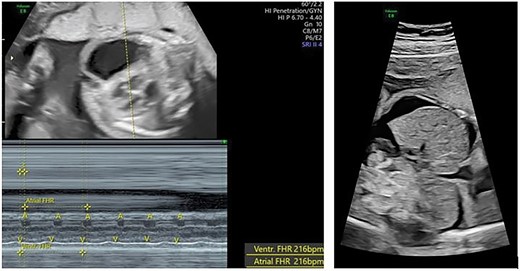 Fetal supraventricular tachycardia (short VA and 1:1 atrial-ventricular conduction) with signs of heart failure (ascites).