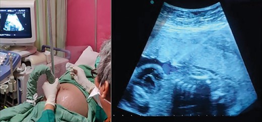 First direct fetal intervention: amiodarone injection into the fetal umbilical vein.