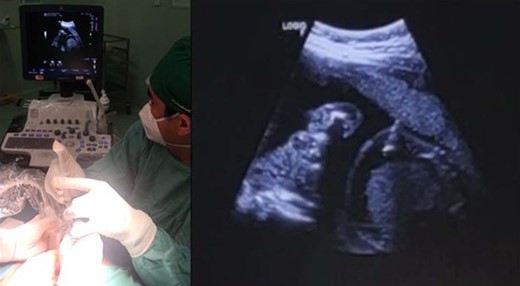 Second direct fetal intervention: amiodarone injection into the fetal peritoneal cavity.